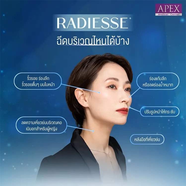 radiesse