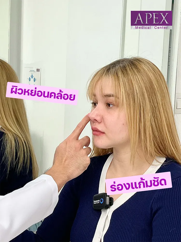 Radiesse คุณแซมมี่ ซาแมนท่า