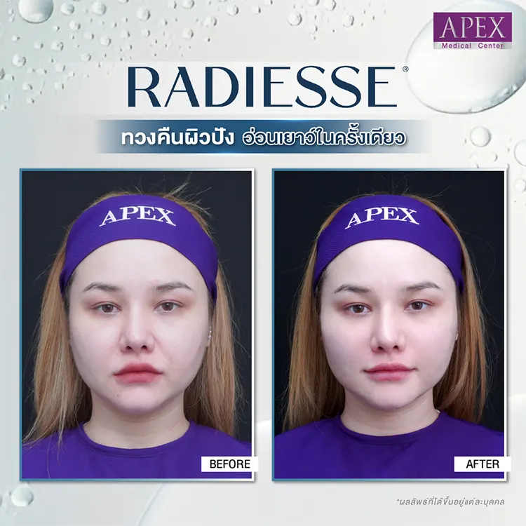 Radiesse คุณแซมมี่ ซาแมนท่า