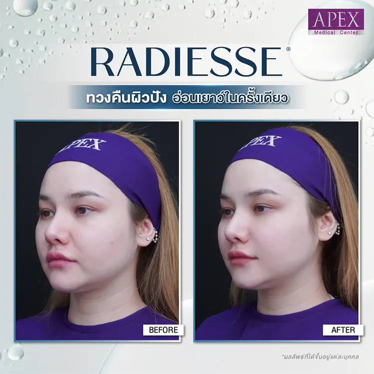 Radiesse คุณแซมมี่ ซาแมนท่า