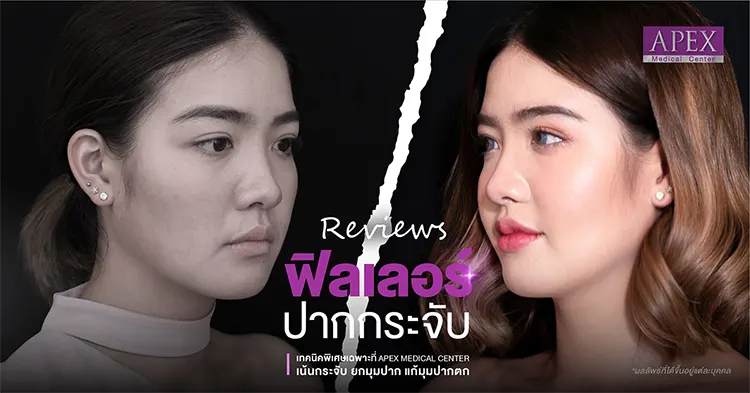 รีวิวฉีดฟิลเลอร์ปากกระจับ คุณพัด