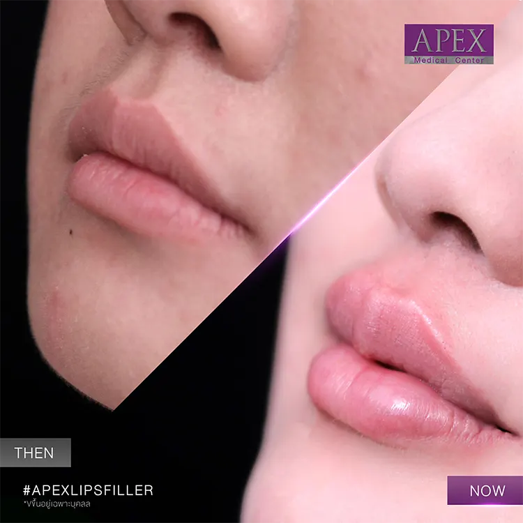 รีวิวฉีดฟิลเลอร์ปากกระจับ