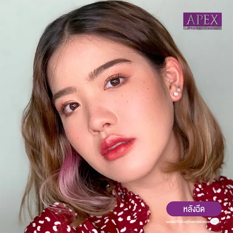 รีวิวฉีดฟิลเลอร์ปากกระจับ