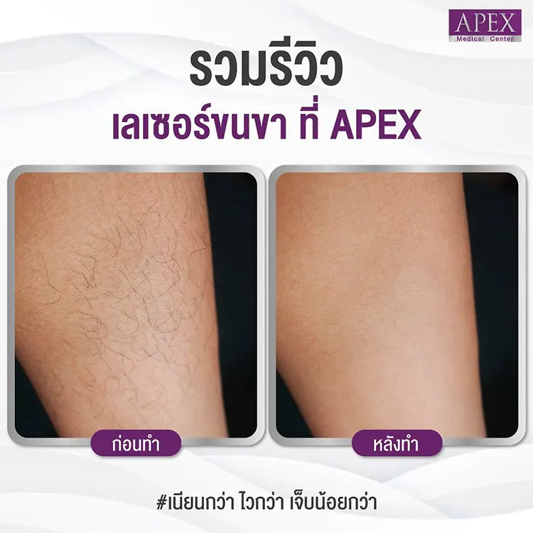 เลเซอร์ขนขา