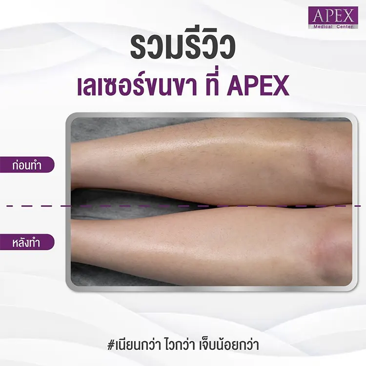 เลเซอร์ขนขา