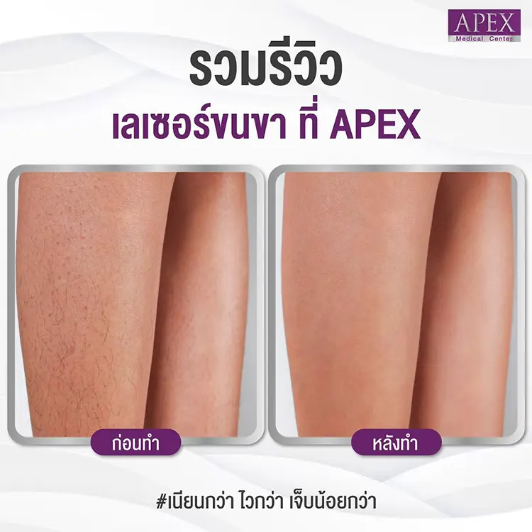 เลเซอร์ขนขา