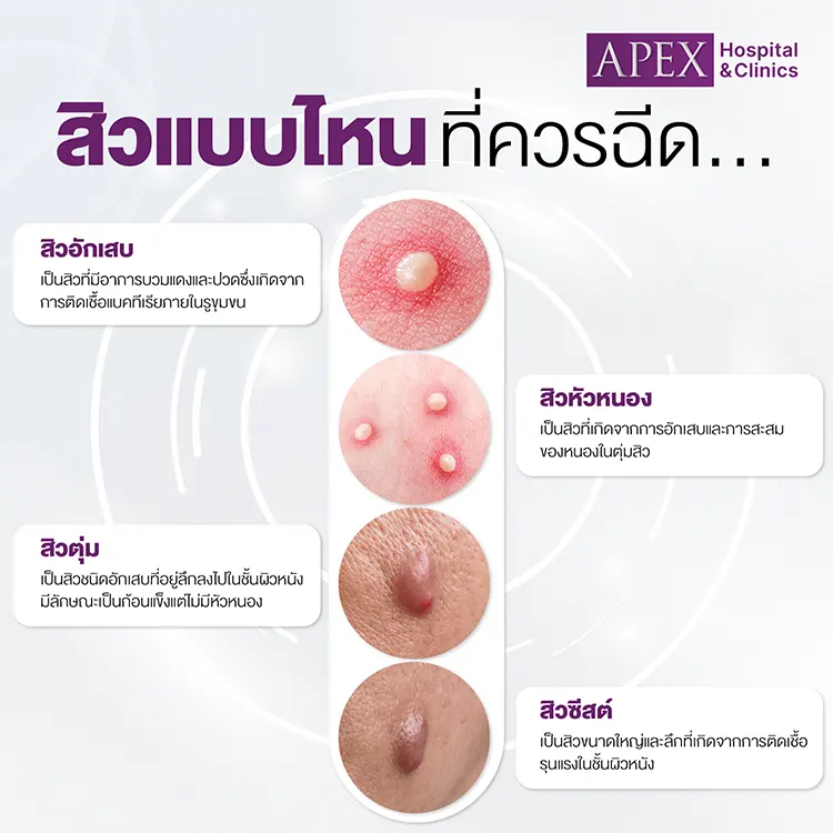 ฉีดสิว