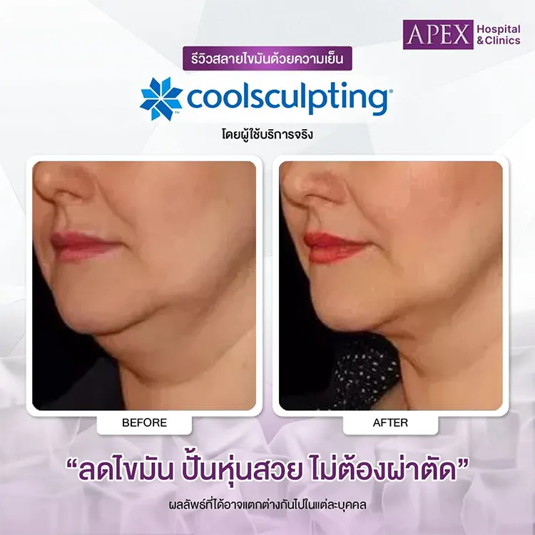 CoolSculpting