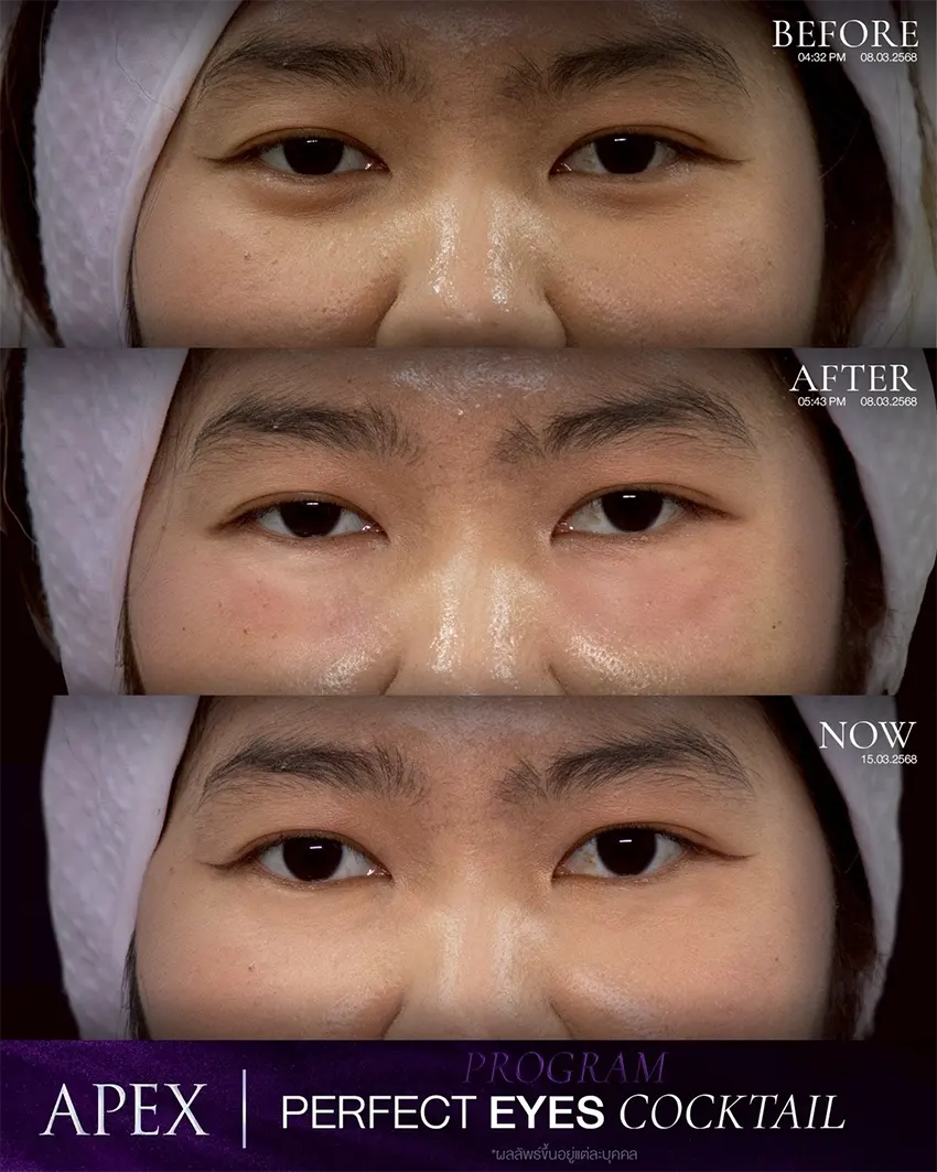 ฉีดฟิลเลอร์ใต้ตา