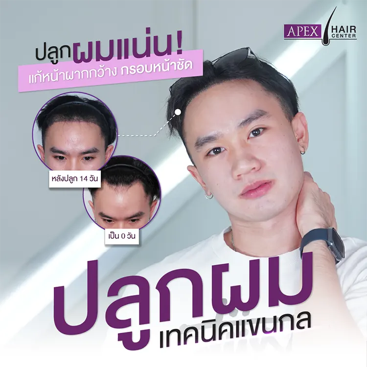 ปลูกผม Advance FUE