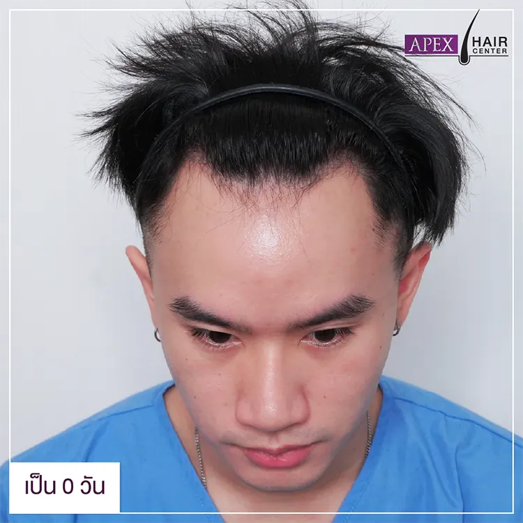ปลูกผม Advance FUE