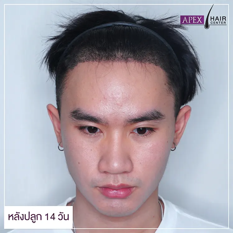 ปลูกผม Advance FUE