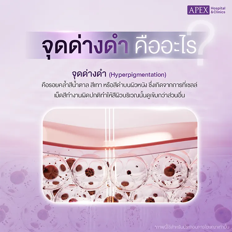 จุดด่างดำ