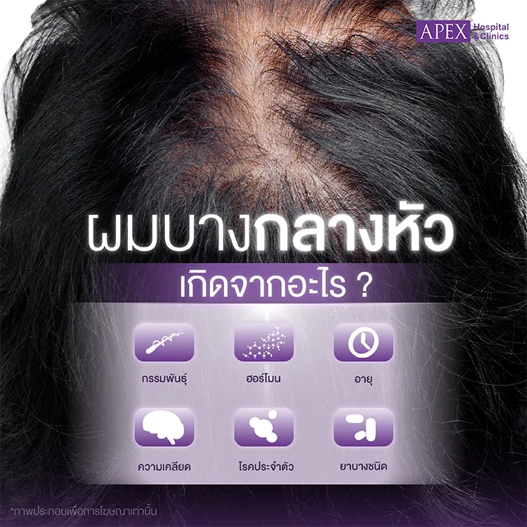 ผมบางกลางหัว