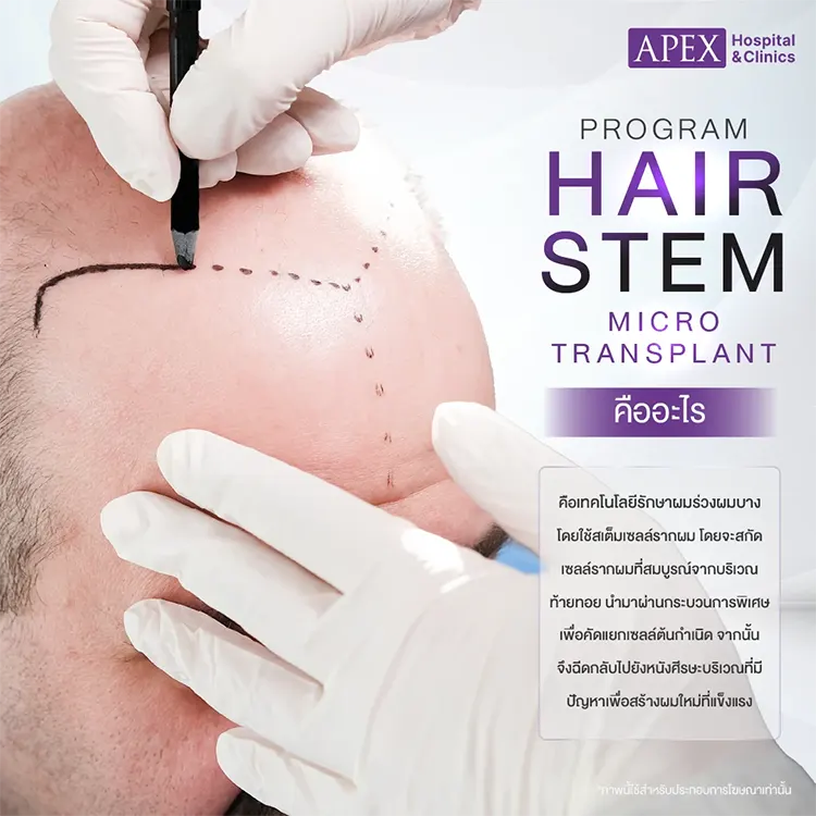 Hair Stem Micro Transplant
