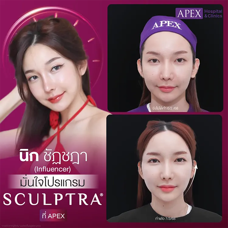 Sculptra ฉีดตรงไหนได้บ้าง