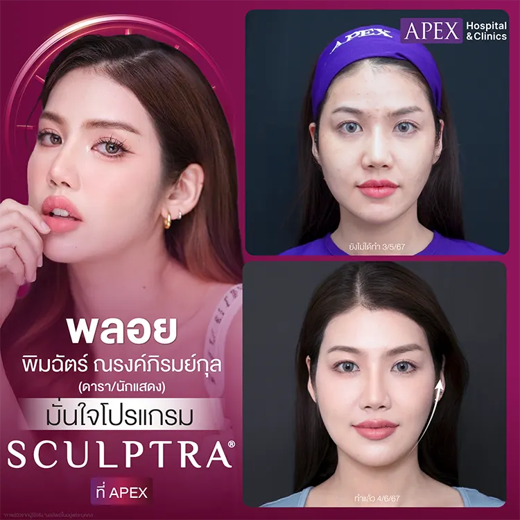 Sculptra ฉีดตรงไหนได้บ้าง