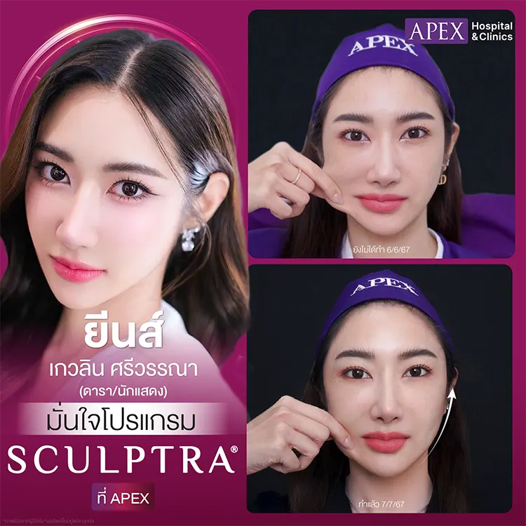 Sculptra ฉีดตรงไหนได้บ้าง