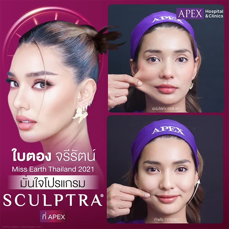 Sculptra ฉีดตรงไหนได้บ้าง