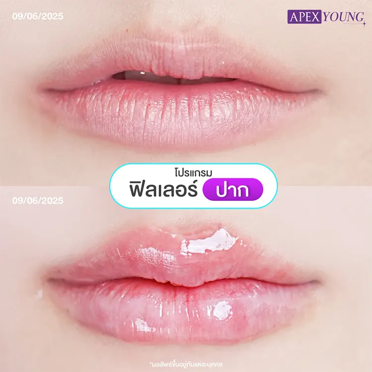 ฉีดปากราคา