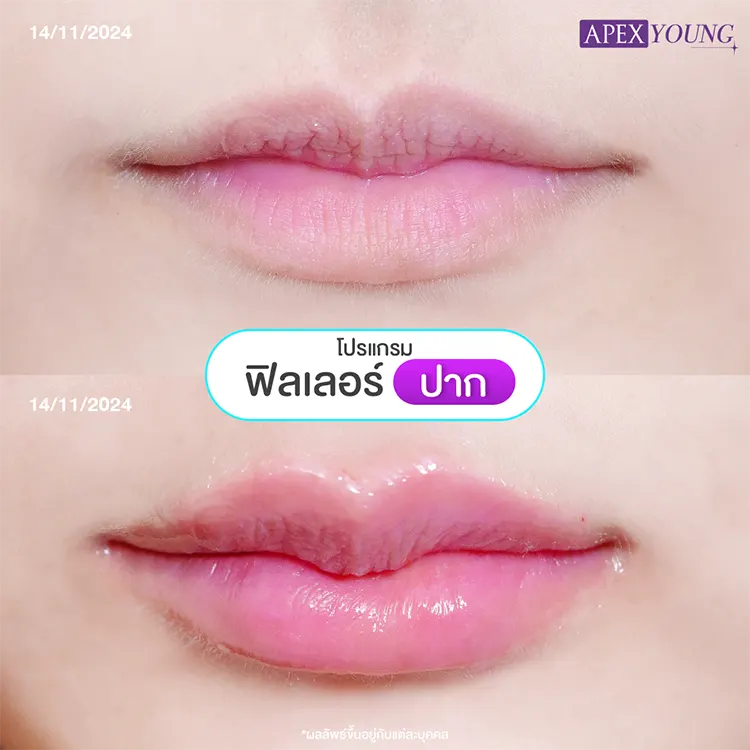 ฉีดปากกระจับราคา