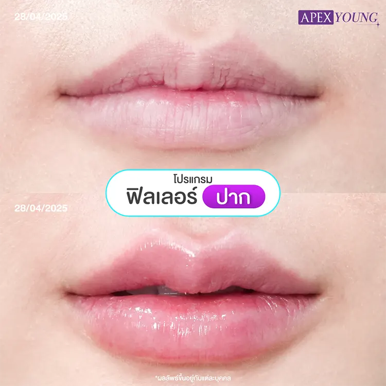ฉีดปากกระจับราคา