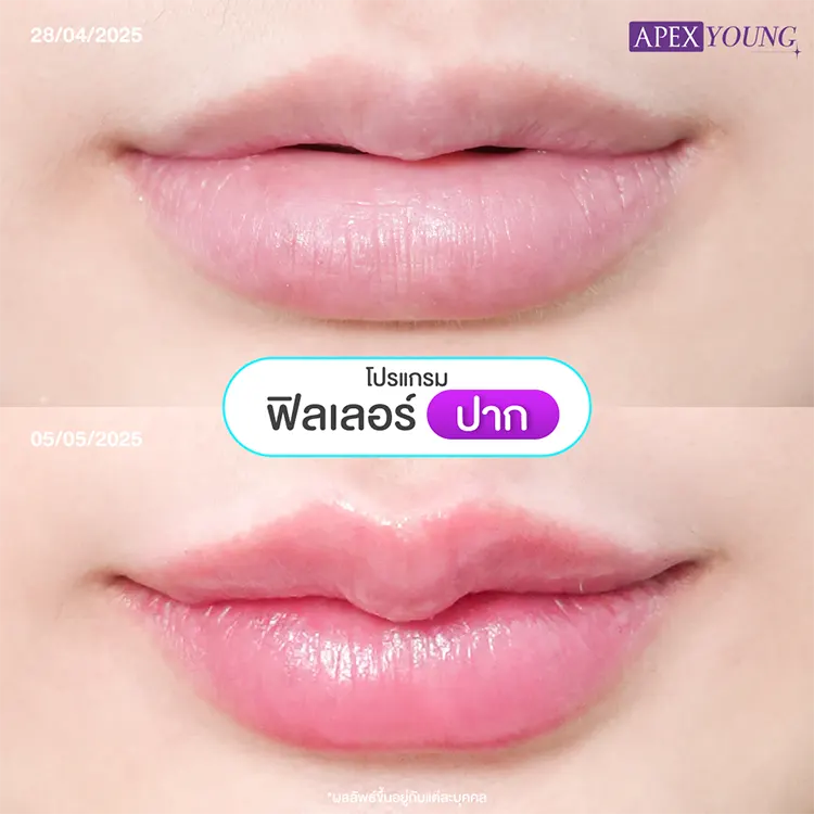 ฉีดปากกระจับราคา