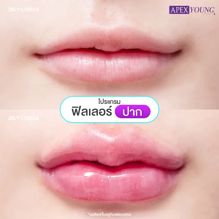 ฉีดปากกระจับราคา