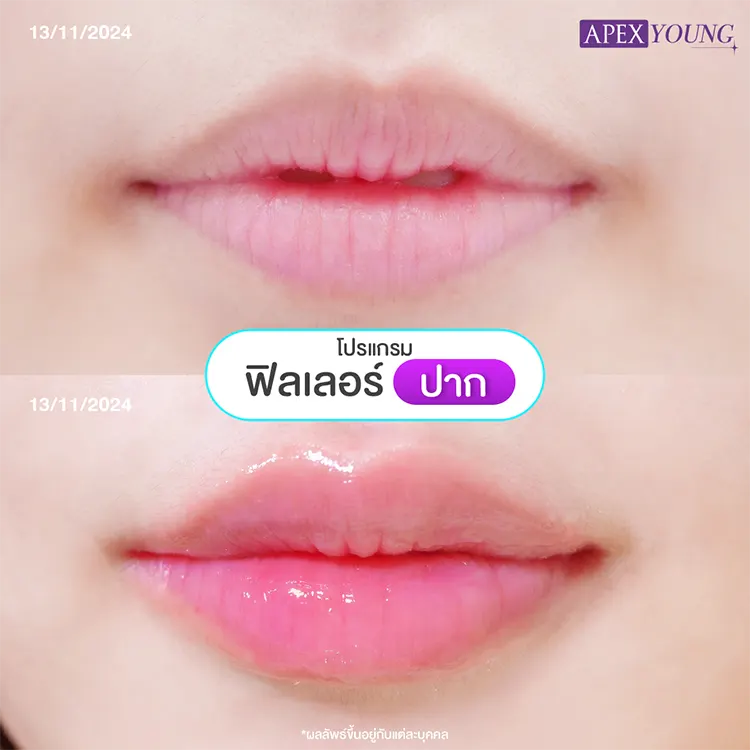ฉีดปากราคา