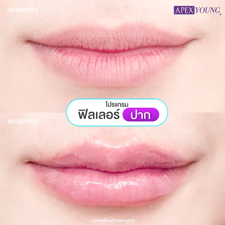ฉีดปากราคา