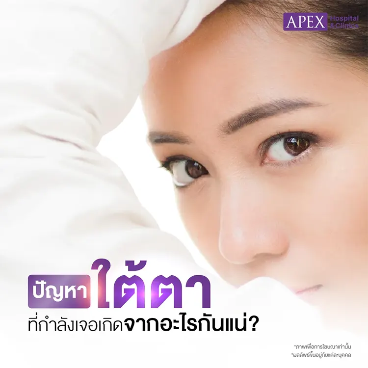 ฉีดใต้ตาราคา