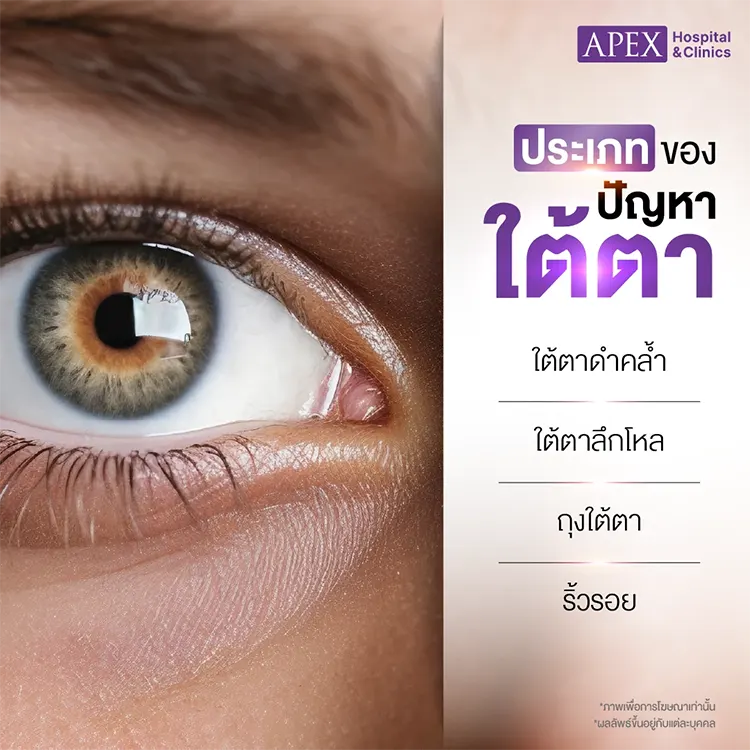 ฉีดใต้ตาราคา