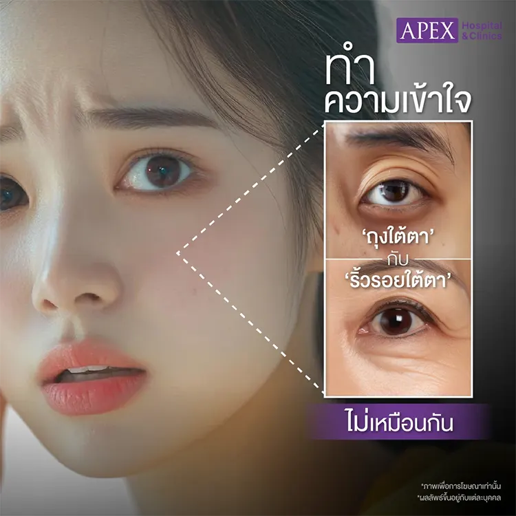 ฉีดโบท็อกถุงใต้ตาราคา