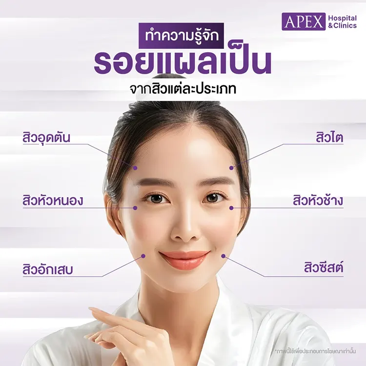 ลดรอยแผลเป็นสิว