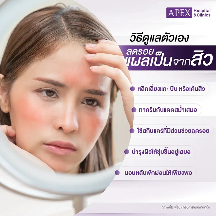 ลดรอยแผลเป็นสิว