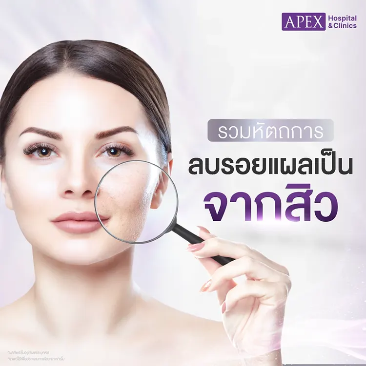 ลบรอยแผลเป็นจากสิว