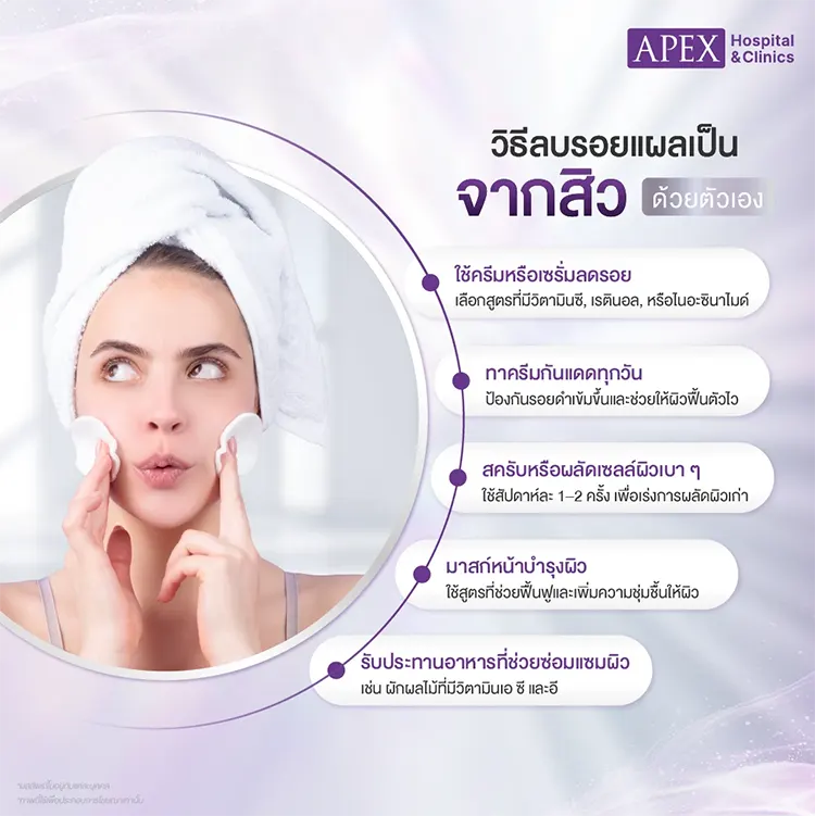 ลบรอยแผลเป็นจากสิว