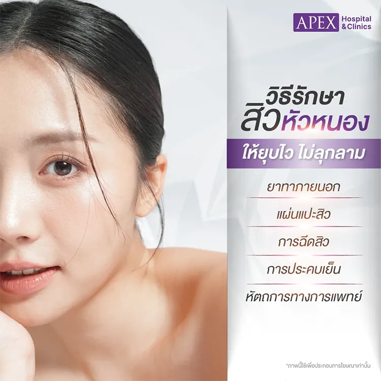 สิวหัวหนอง