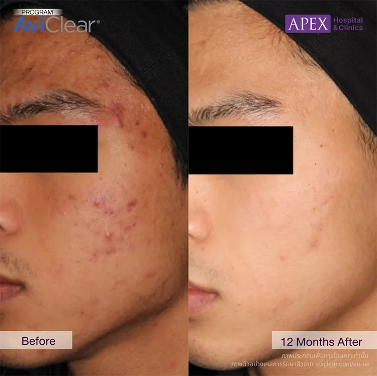 สิวหัวหนอง