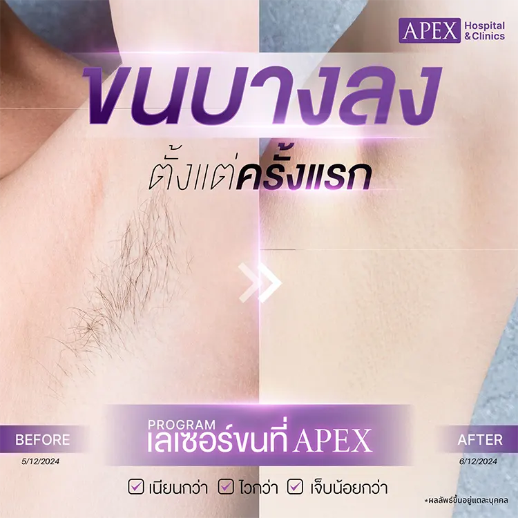 เลเซอร์ขนคุด