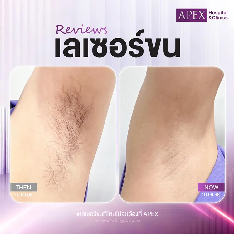 กำจัดขนรักแร้