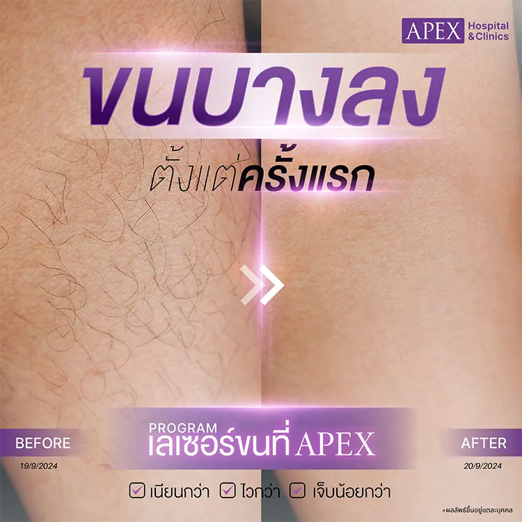 กำจัดขนขา