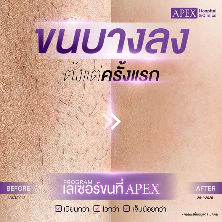 เครื่องเลเซอร์ขน