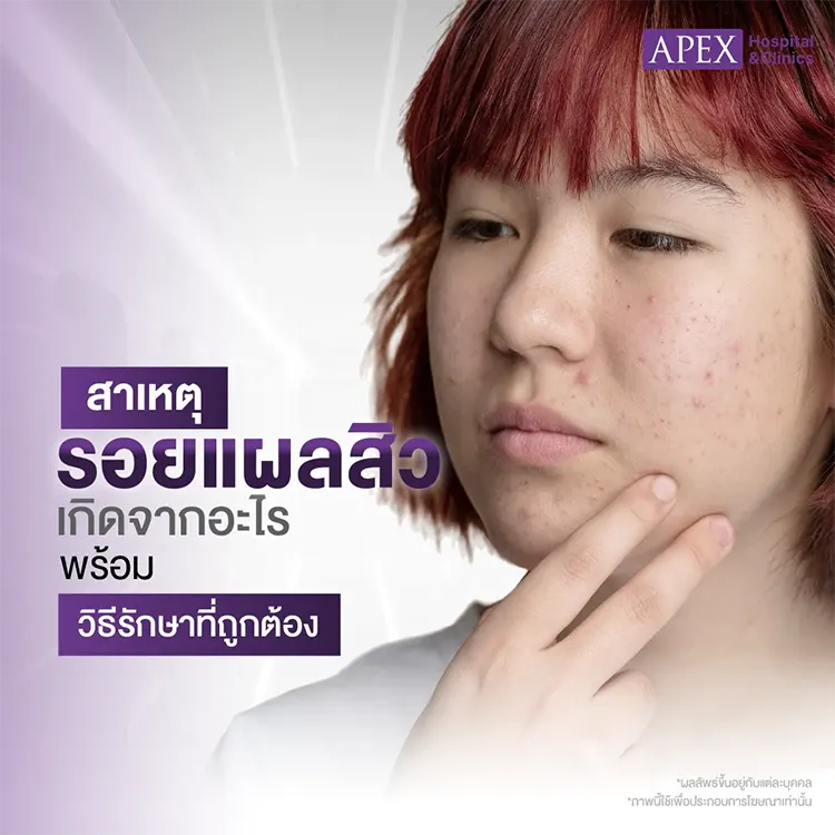 รอยแผลสิว