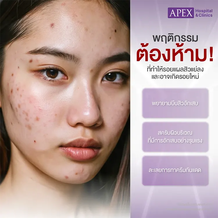 รอยแผลสิว
