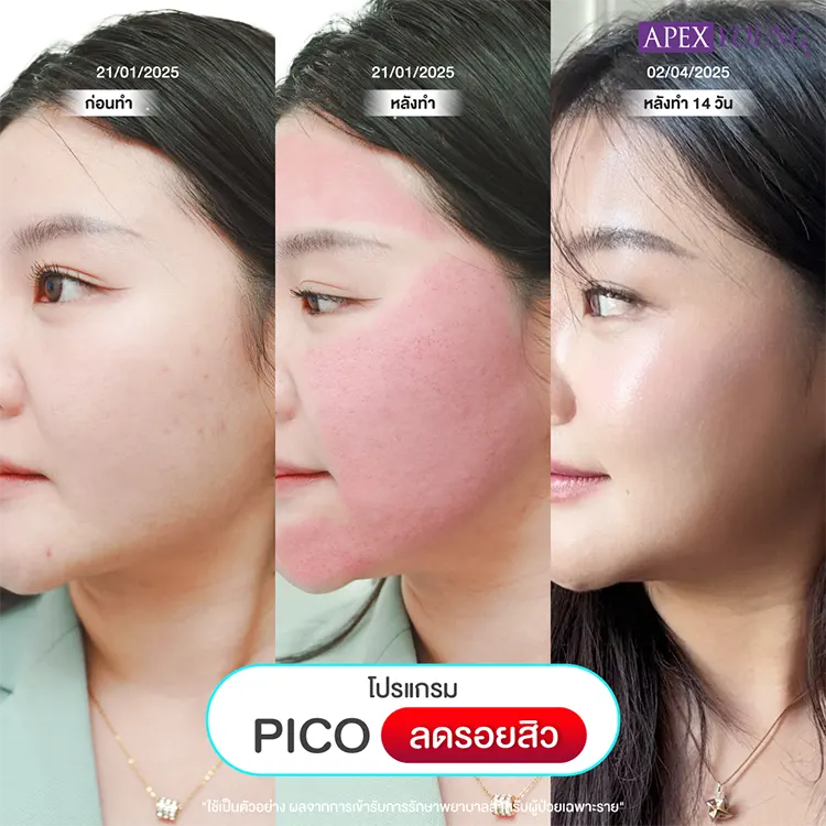 รักษารอยสิว