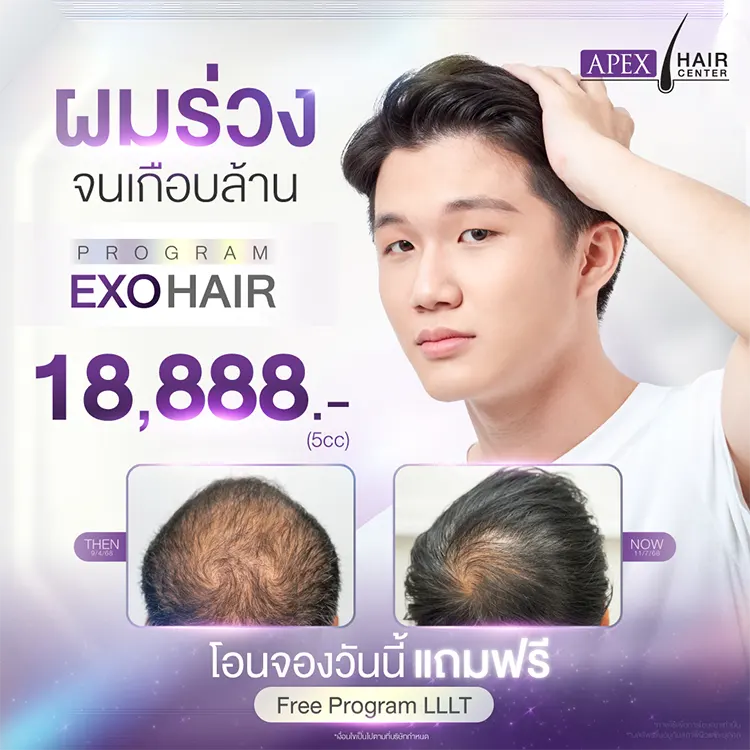 ปลูกผม