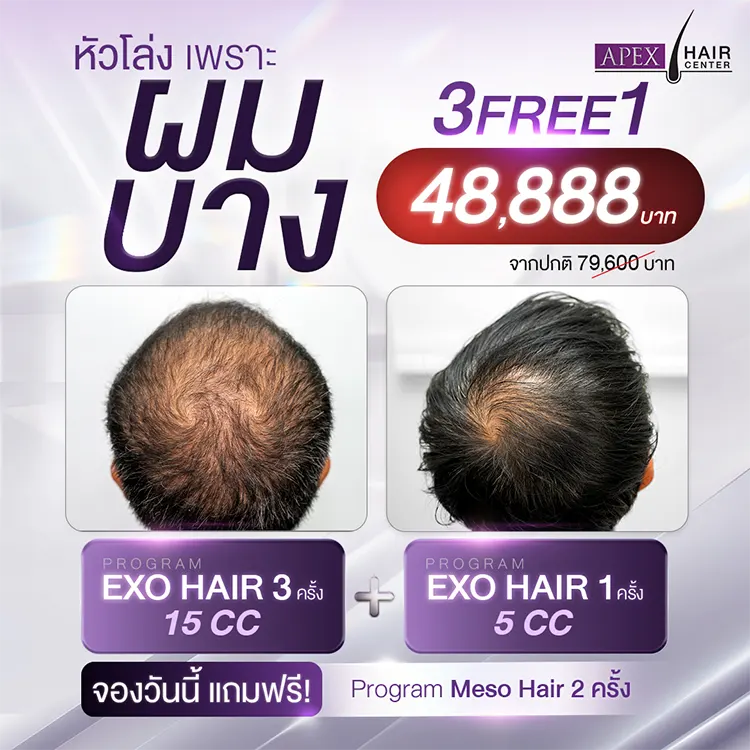 ปลูกผม
