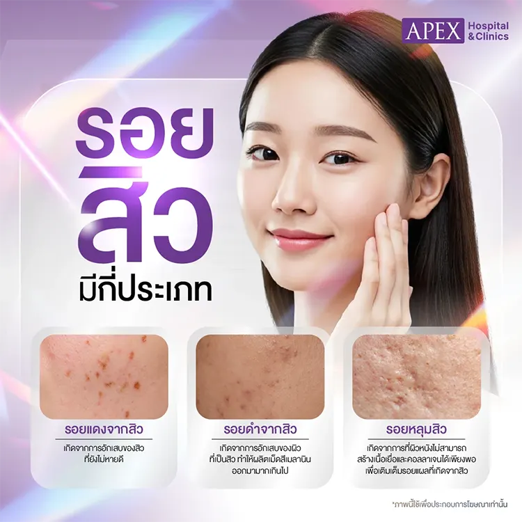 รอยสิว