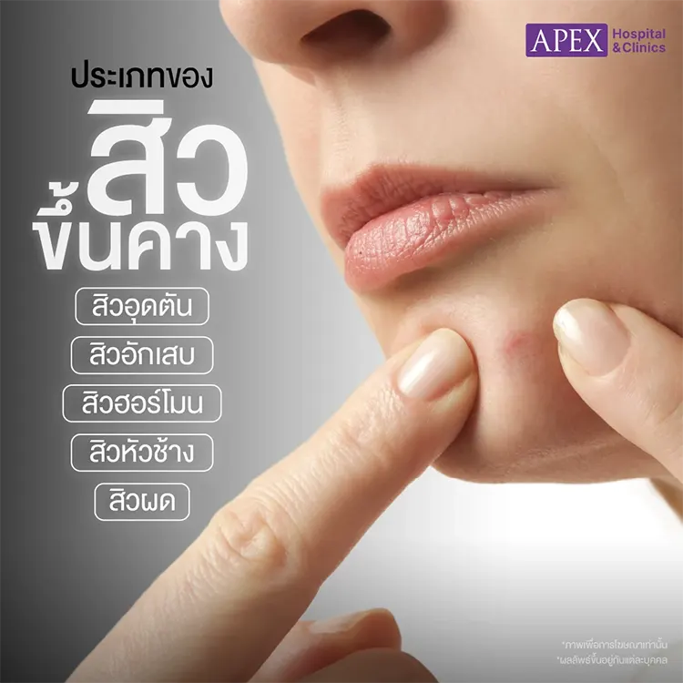 สิวขึ้นคาง